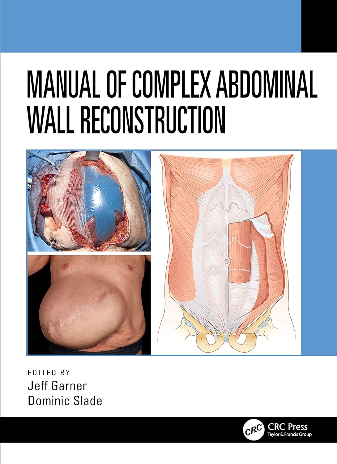 Manual of Complex Abdominal Wall Reconstruction 1st Edition